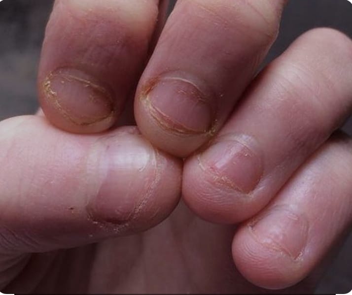 Nägelkauen abgewöhnen